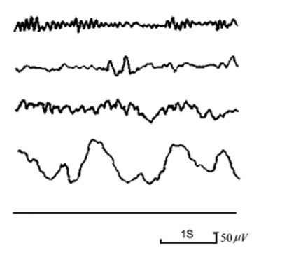 脑电图的简单简介